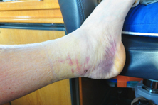 Paul’s foot – Heat Instead of Ice